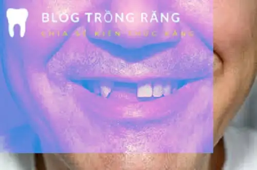 nằm mơ thấy rụng 1 cái răng