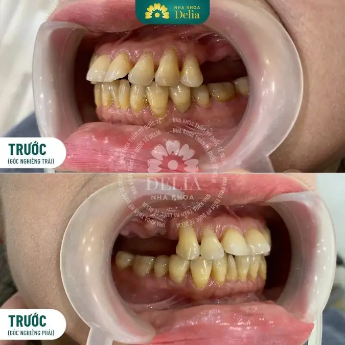 Giải Mã Giấc Mơ Thấy Rụng Răng: Điềm Lành Hay Dữ?