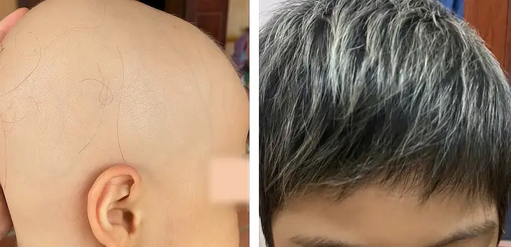 mơ thấy người khác rụng răng