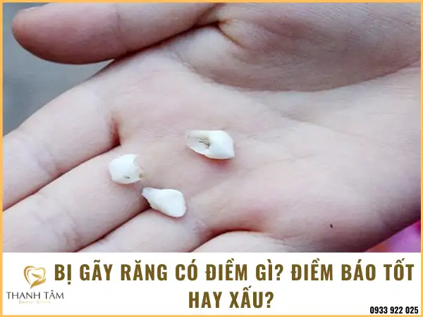 Nằm Mơ Thấy Gãy Răng Cửa: Giải Mã Điềm Báo Lành Dữ và Ý Nghĩa Sâu Sắc