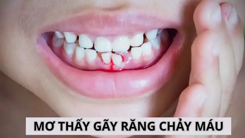 nằm mơ gãy răng cửa