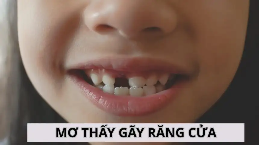 Giải Mã Giấc Mơ Thấy Rụng Răng Cửa Hàm Trên: Điềm Báo Gì Cho Bạn?