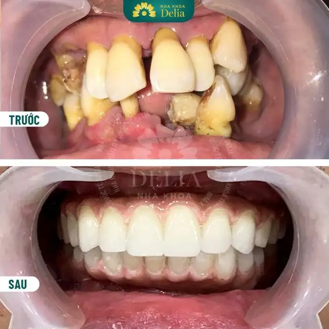 Giải mã giấc mơ thấy mình bị rụng răng: Ý nghĩa tâm linh và khoa học
