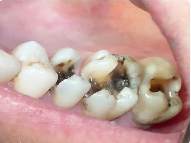 {mơ thấy sâu răng}