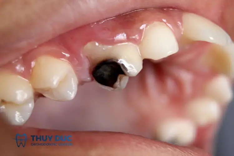 Giải Mã Giấc Mơ Rụng Răng: Điềm Lành Hay Dữ, Ý Nghĩa Sâu Sắc Bạn Cần Biết