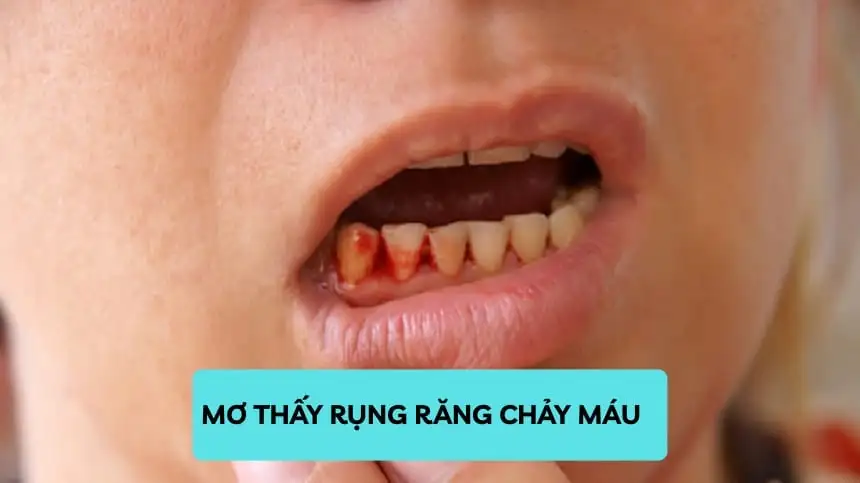 mơ thấy răng chảy máu