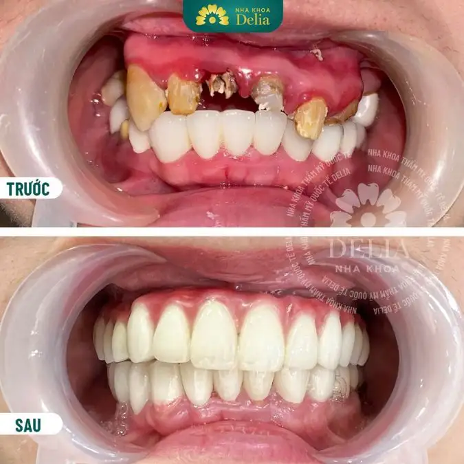 nằm mơ rụng răng không chảy máu