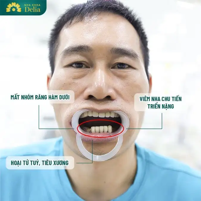 mơ gãy răng dưới