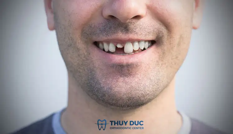 nằm mơ mình bị gãy răng